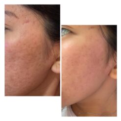 سرم رتینول سراوی پوست چرب و مختلط (100%اصل+به قیمت پخش) آبی ضد جوش 44 61sr23POMpL