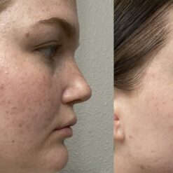 سرم رتینول سراوی پوست چرب و مختلط (100%اصل+به قیمت پخش) آبی ضد جوش 43 61zIuwZ3SL