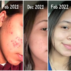 سرم رتینول سراوی پوست چرب و مختلط (100%اصل+به قیمت پخش) آبی ضد جوش 41 71AooFIAcNL