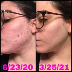 سرم رتینول سراوی پوست چرب و مختلط (100%اصل+به قیمت پخش) آبی ضد جوش 51 A1qBbsVFGOL scaled