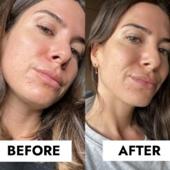 شوینده سراوی ضد جوش و آکنه (100%اصل+به قیمت پخش) بلمیش ضد جوش پوست 14 BIQ BEFORE AFTER 51