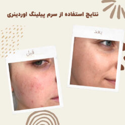 سرم پیلینگ اوردینری قرمز (100%اصل+ارسال فوری) لایه بردار 27 before aftemr ordinary peeling 1