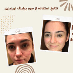سرم پیلینگ اوردینری قرمز (100%اصل+ارسال فوری) لایه بردار 26 before aftemr ordinary peeling 2