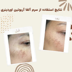 سرم آلفا آربوتین اوردینری (100%اصل+به قیمت پخش) ضد لک 39 before after Alpha Arbutin 1 min