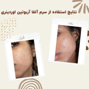 سرم آلفا آربوتین اوردینری (100%اصل+به قیمت پخش) ضد لک 58 before after Alpha Arbutin 10 min