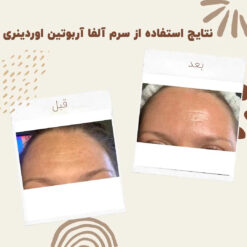 سرم آلفا آربوتین اوردینری (100%اصل+به قیمت پخش) ضد لک 29 before after Alpha Arbutin 11 min