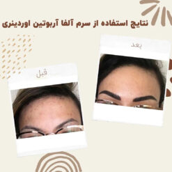 سرم آلفا آربوتین اوردینری (100%اصل+به قیمت پخش) ضد لک 28 before after Alpha Arbutin 12 min