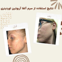 سرم آلفا آربوتین اوردینری (100%اصل+به قیمت پخش) ضد لک 27 before after Alpha Arbutin 13 min