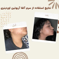 سرم آلفا آربوتین اوردینری (100%اصل+به قیمت پخش) ضد لک 38 before after Alpha Arbutin 2 min