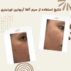 سرم آلفا آربوتین اوردینری (100%اصل+به قیمت پخش) ضد لک 37 before after Alpha Arbutin 3 min