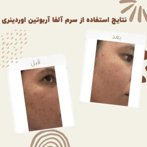 before after Alpha Arbutin 3 min