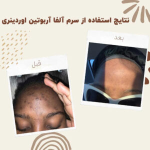 before after Alpha Arbutin 4 min