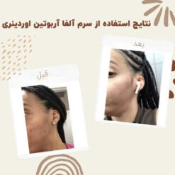 سرم آلفا آربوتین اوردینری (100%اصل+به قیمت پخش) ضد لک 35 before after Alpha Arbutin 5 min
