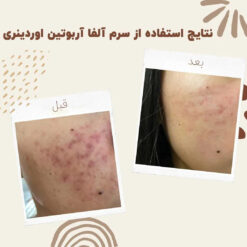 سرم آلفا آربوتین اوردینری (100%اصل+به قیمت پخش) ضد لک 34 before after Alpha Arbutin 6 min