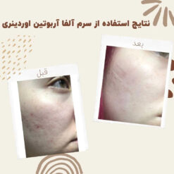سرم آلفا آربوتین اوردینری (100%اصل+به قیمت پخش) ضد لک 33 before after Alpha Arbutin 7 min