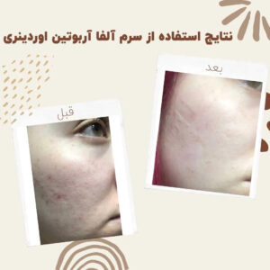 before after Alpha Arbutin 7 min