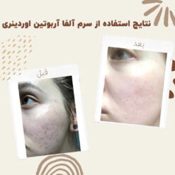 سرم آلفا آربوتین اوردینری (100%اصل+به قیمت پخش) ضد لک 32 before after Alpha Arbutin 8 min