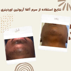 سرم آلفا آربوتین اوردینری (100%اصل+به قیمت پخش) ضد لک 31 before after Alpha Arbutin 9 min