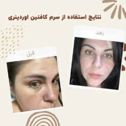 سرم کافئین اوردینری (100%اصل+به قیمت پخش) ضد تیرگی و پف دور چشم 24 before after Caffeine 1 min