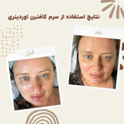 سرم کافئین اوردینری (100%اصل+به قیمت پخش) ضد تیرگی و پف دور چشم 23 before after Caffeine 2 min