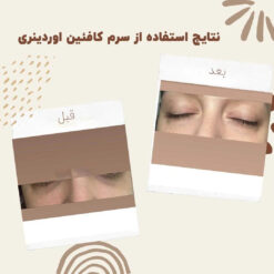 سرم کافئین اوردینری (100%اصل+به قیمت پخش) ضد تیرگی و پف دور چشم 22 before after Caffeine 3 min