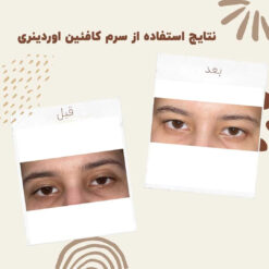 سرم کافئین اوردینری (100%اصل+به قیمت پخش) ضد تیرگی و پف دور چشم 21 before after Caffeine 4 min