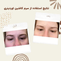 سرم کافئین اوردینری (100%اصل+به قیمت پخش) ضد تیرگی و پف دور چشم 20 before after Caffeine 5 min