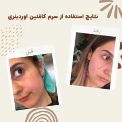 سرم کافئین اوردینری (100%اصل+به قیمت پخش) ضد تیرگی و پف دور چشم 19 before after Caffeine 6 min