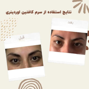 سرم کافئین اوردینری (100%اصل+به قیمت پخش) ضد تیرگی و پف دور چشم 40 before after Caffeine 7 min