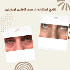 سرم کافئین اوردینری (100%اصل+به قیمت پخش) ضد تیرگی و پف دور چشم 17 before after Caffeine 8 min
