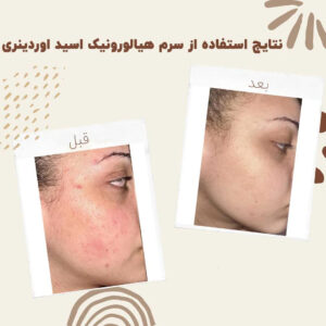 سرم آبرسان هیالورونیک اسید اوردینری (100%اصل+به قیمت پخش) پوست چرب خشک مختلط 16 before after Hyaluronic Acid 1 min