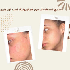 سرم آبرسان هیالورونیک اسید اوردینری (100%اصل+به قیمت پخش) پوست چرب خشک مختلط 10 before after Hyaluronic Acid 2 min