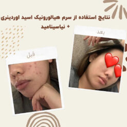 سرم آبرسان هیالورونیک اسید اوردینری (100%اصل+به قیمت پخش) پوست چرب خشک مختلط 9 before after Hyaluronic Acid 3 min