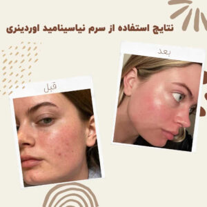 before after Niacinamide 1 min