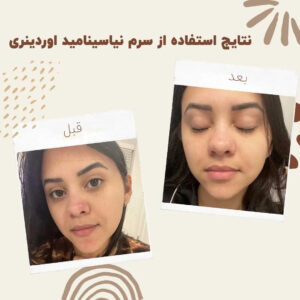 before after Niacinamide 10 min