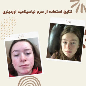 before after Niacinamide 3 min