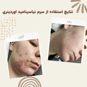 before after Niacinamide 4 min