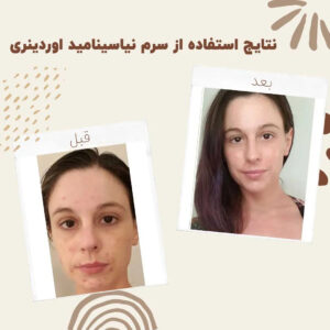 before after Niacinamide 5 min