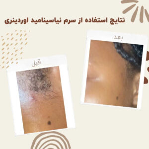 before after Niacinamide 6 min