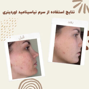 before after Niacinamide 8 min