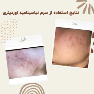 before after Niacinamide 9 min