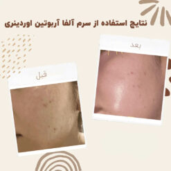 سرم آلفا آربوتین اوردینری (100%اصل+به قیمت پخش) ضد لک 25 before after arbutin 10