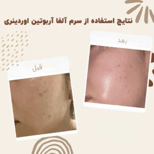 before after arbutin 10