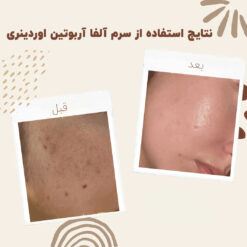 سرم آلفا آربوتین اوردینری (100%اصل+به قیمت پخش) ضد لک 26 before after arbutin 9