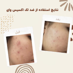 سرم ضد لک اکسیس وای اصل (به قیمت پخش) رفع جای جوش 15 before after axis y 1