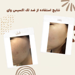 سرم ضد لک اکسیس وای اصل (به قیمت پخش) رفع جای جوش 14 before after axis y 2
