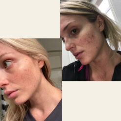 کرم حلزون کوزارکس اصل (به قیمت پخش) مرطوب کننده 14 before after axis y 4 2