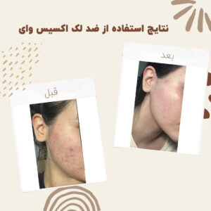 before after axis y 4