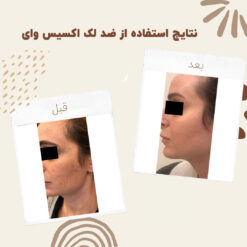 سرم ضد لک اکسیس وای اصل (به قیمت پخش) رفع جای جوش 11 before after axis y 5