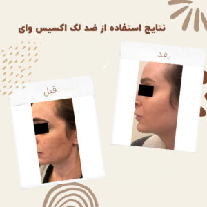 before after axis y 5